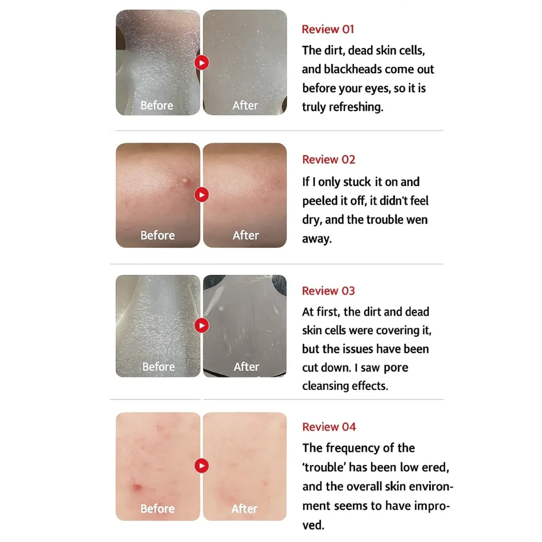 Mascarilla exfoliante con ácido hipocloroso/mascarilla Hypochlorous Acid Peel Mask (3ea) Medicube